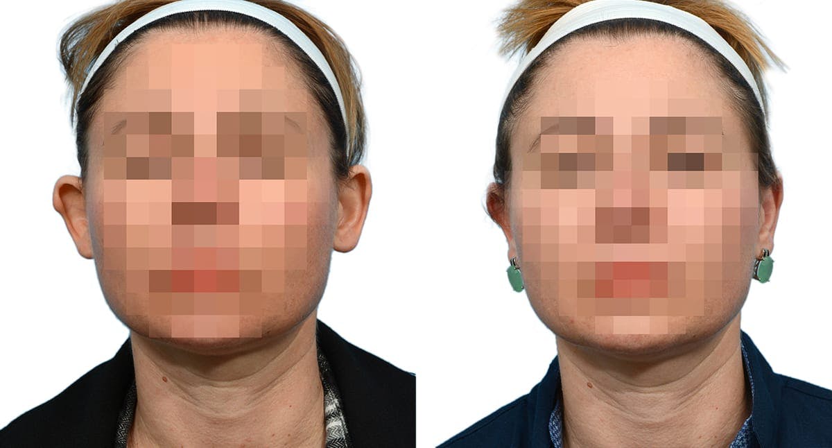 Otoplasty (Ear Surgery) Before & After Gallery - Patient 382083 - Image 1