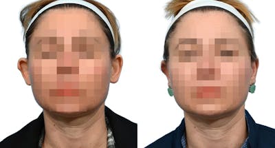 Otoplasty (Ear Surgery) Before & After Gallery - Patient 382083 - Image 1