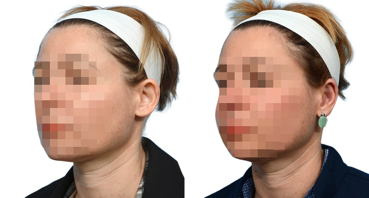 Otoplasty (Ear Surgery) Before & After Gallery - Patient 382083 - Image 3
