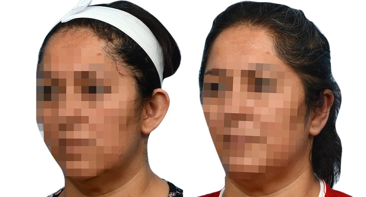 Otoplasty (Ear Surgery) Before & After Gallery - Patient 149661 - Image 4