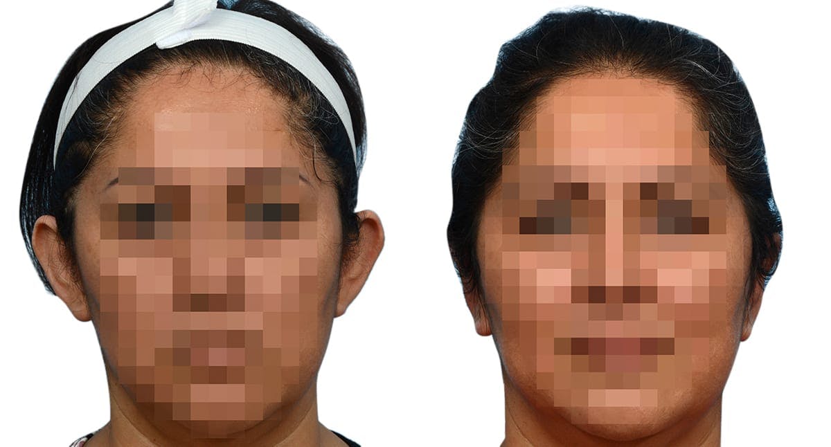 Otoplasty (Ear Surgery) Before & After Gallery - Patient 149661 - Image 1