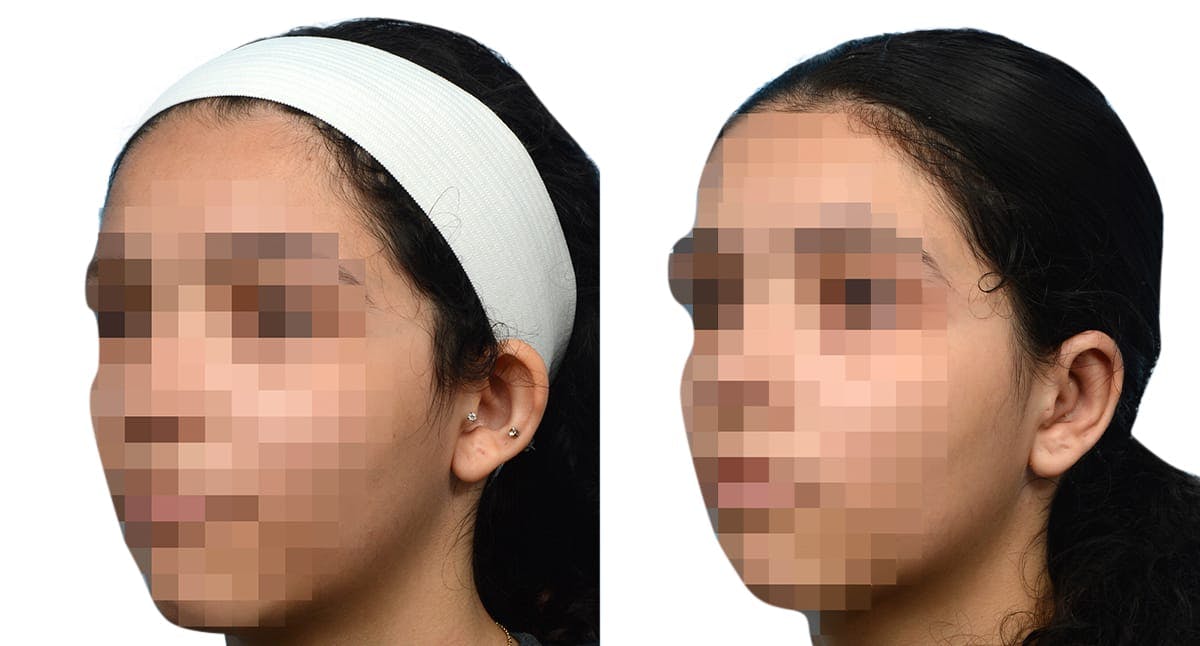 Otoplasty (Ear Surgery) Before & After Gallery - Patient 138735 - Image 3