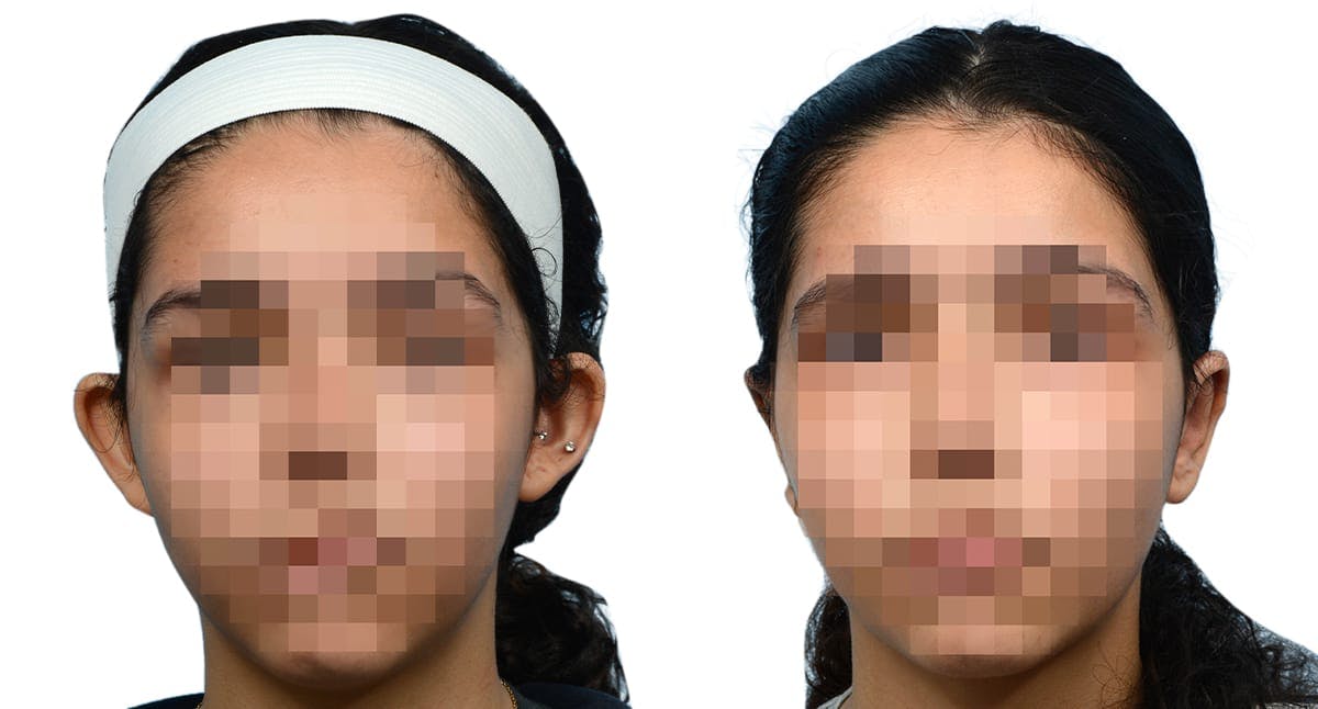 Otoplasty (Ear Surgery) Before & After Gallery - Patient 138735 - Image 1