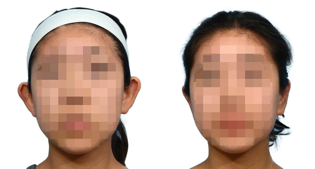 Otoplasty (Ear Surgery) Before & After Gallery - Patient 159444 - Image 1