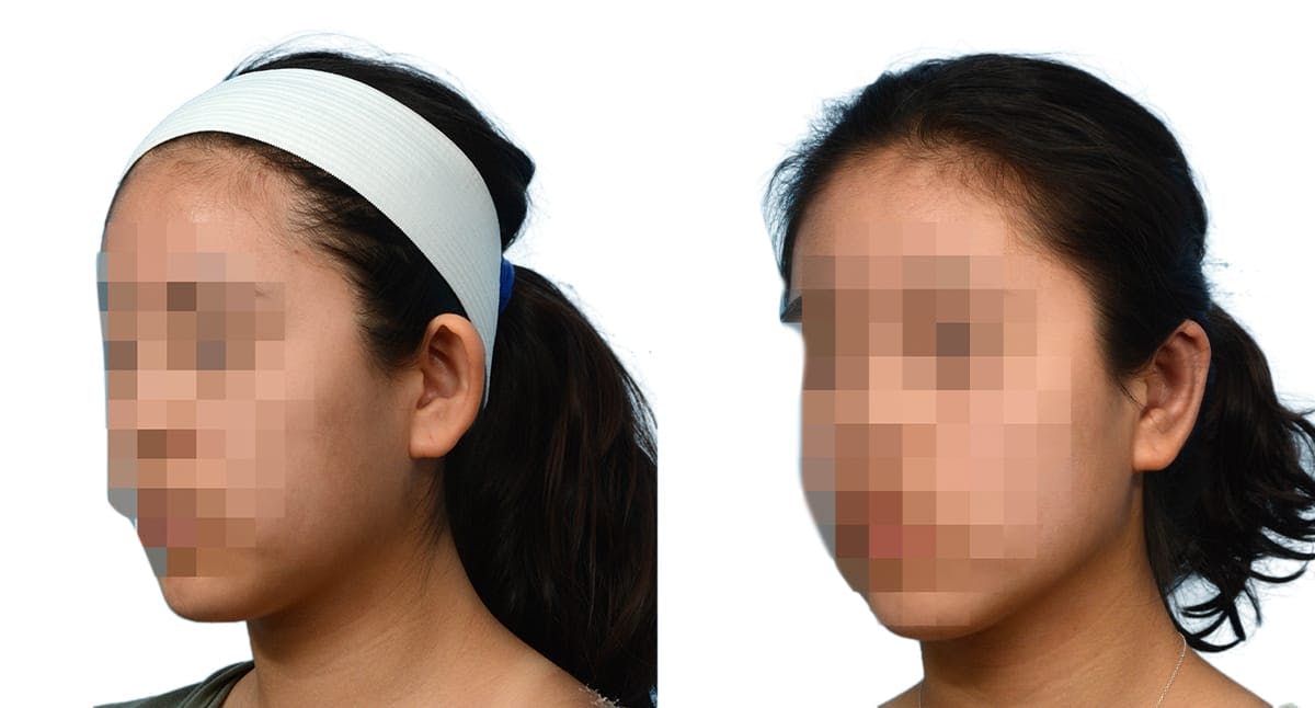 Otoplasty (Ear Surgery) Before & After Gallery - Patient 159444 - Image 3