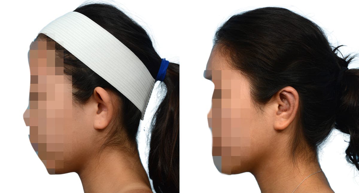Otoplasty (Ear Surgery) Before & After Gallery - Patient 159444 - Image 4