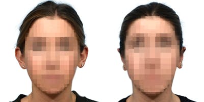 Otoplasty (Ear Surgery) Before & After Gallery - Patient 192926 - Image 1