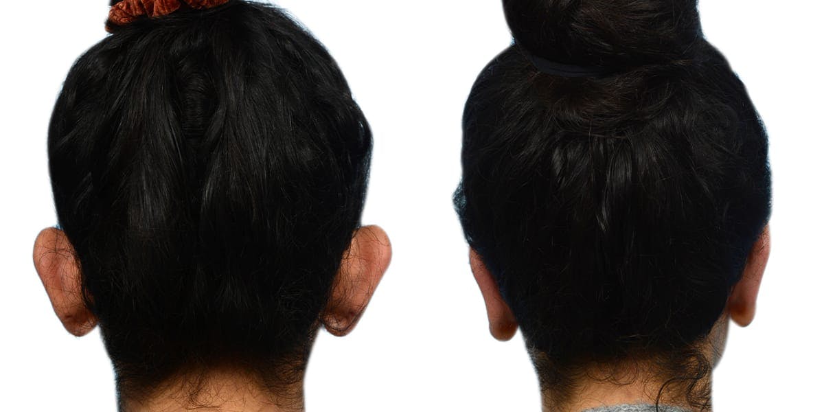 Otoplasty (Ear Surgery) Before & After Gallery - Patient 597596 - Image 6