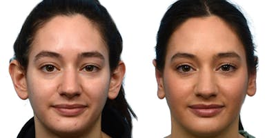 Otoplasty (Ear Surgery) Before & After Gallery - Patient 332269 - Image 1