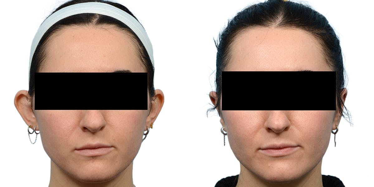 Otoplasty (Ear Surgery) Before & After Gallery - Patient 202121 - Image 1