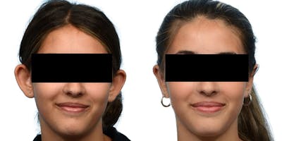 Otoplasty (Ear Surgery) Before & After Gallery - Patient 145790 - Image 1