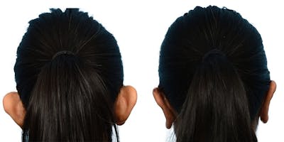Otoplasty (Ear Surgery) Before & After Gallery - Patient 374206 - Image 1