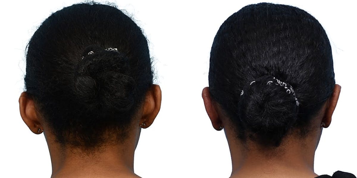 Otoplasty (Ear Surgery) Before & After Gallery - Patient 420403 - Image 1