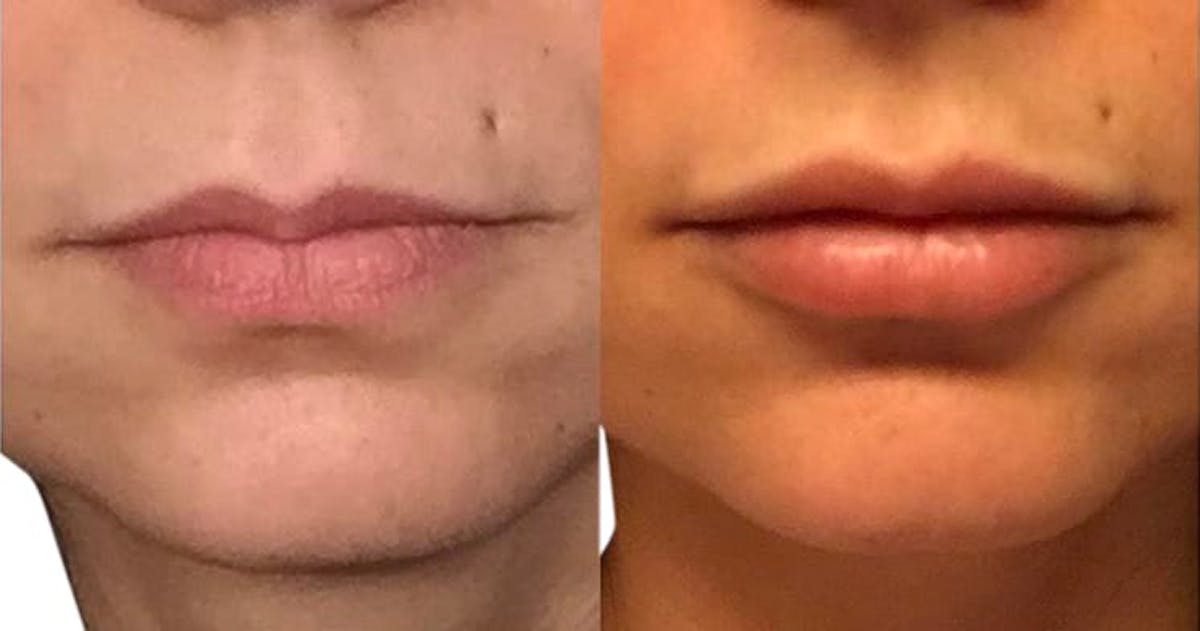 Lip Enhancement Before & After Gallery - Patient 247127 - Image 1