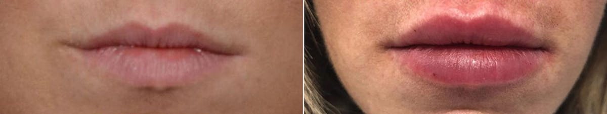 Lip Enhancement Before & After Gallery - Patient 193507 - Image 1