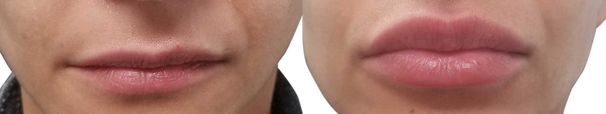 Lip Enhancement Before & After Gallery - Patient 144247 - Image 1