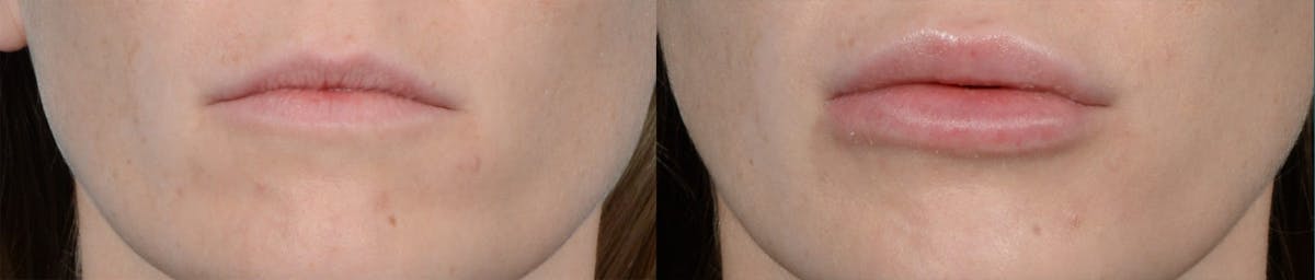 Lip Enhancement Before & After Gallery - Patient 994424 - Image 1