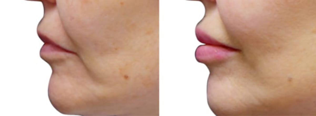 Lip Enhancement Before & After Gallery - Patient 190552 - Image 1