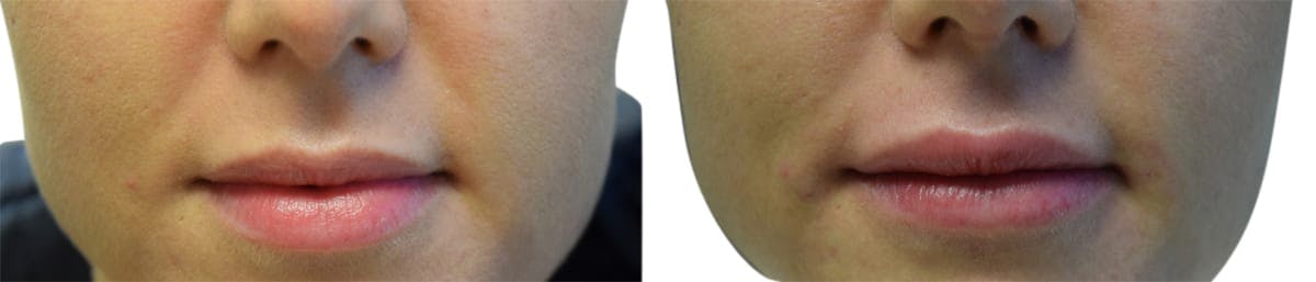 Lip Enhancement Before & After Gallery - Patient 170818 - Image 1