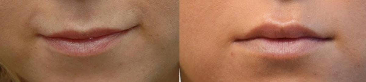 Lip Enhancement Before & After Gallery - Patient 921691 - Image 1