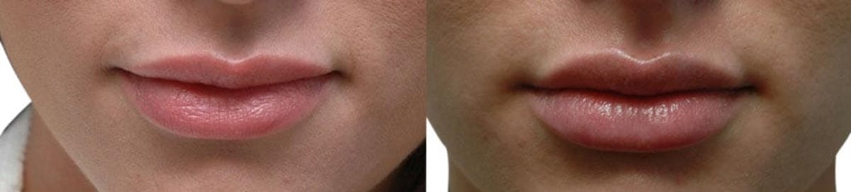 Lip Enhancement Before & After Gallery - Patient 392348 - Image 1