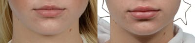 Lip Enhancement Before & After Gallery - Patient 841286 - Image 1