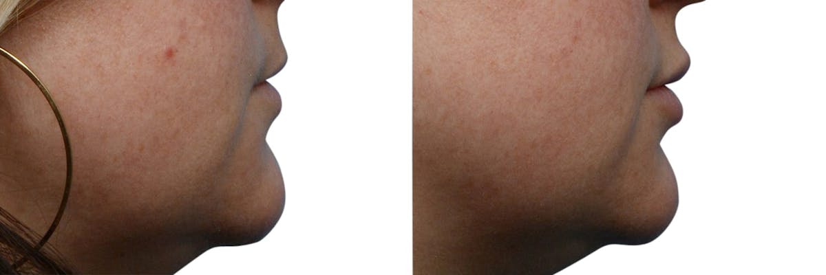 Lip Enhancement Before & After Gallery - Patient 163461 - Image 2