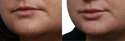 Lip Enhancement Before & After Gallery - Patient 163461 - Image 1