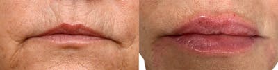 Lip Enhancement Before & After Gallery - Patient 295852 - Image 1