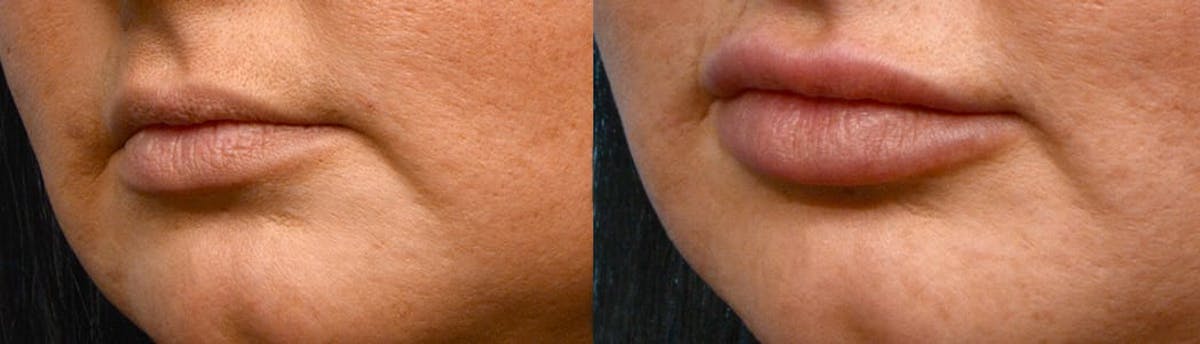 Lip Enhancement Before & After Gallery - Patient 369345 - Image 1