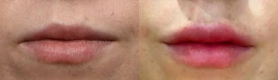 Lip Enhancement Before & After Gallery - Patient 251630 - Image 1