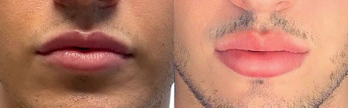 Lip Enhancement Before & After Gallery - Patient 419490 - Image 1