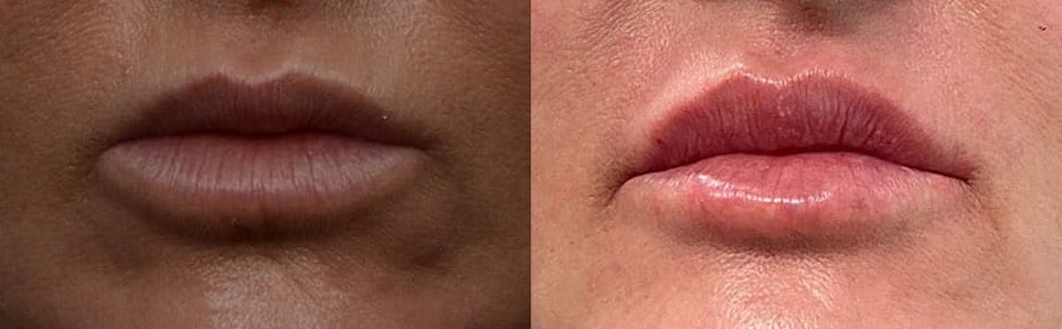 Lip Enhancement Before & After Gallery - Patient 316095 - Image 1