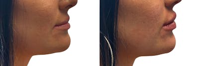 Lip Enhancement Before & After Gallery - Patient 233852 - Image 1