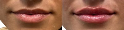 Lip Enhancement Before & After Gallery - Patient 394197 - Image 1