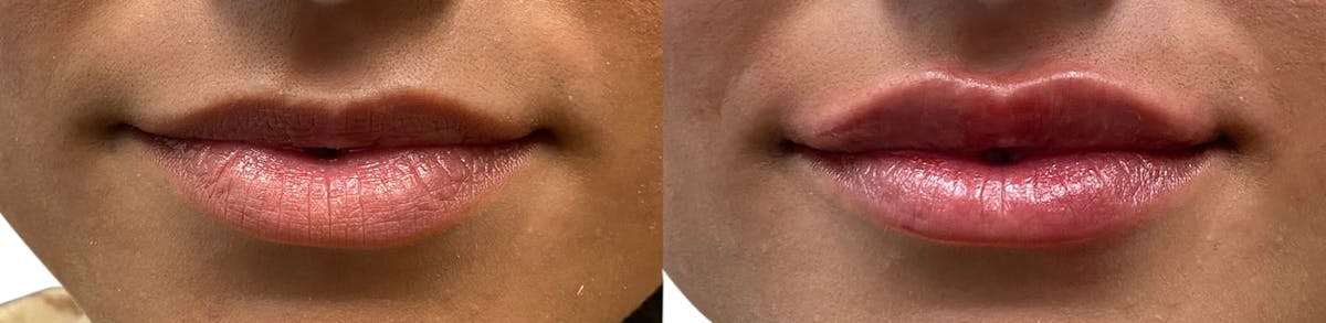 Lip Enhancement Before & After Gallery - Patient 394197 - Image 1