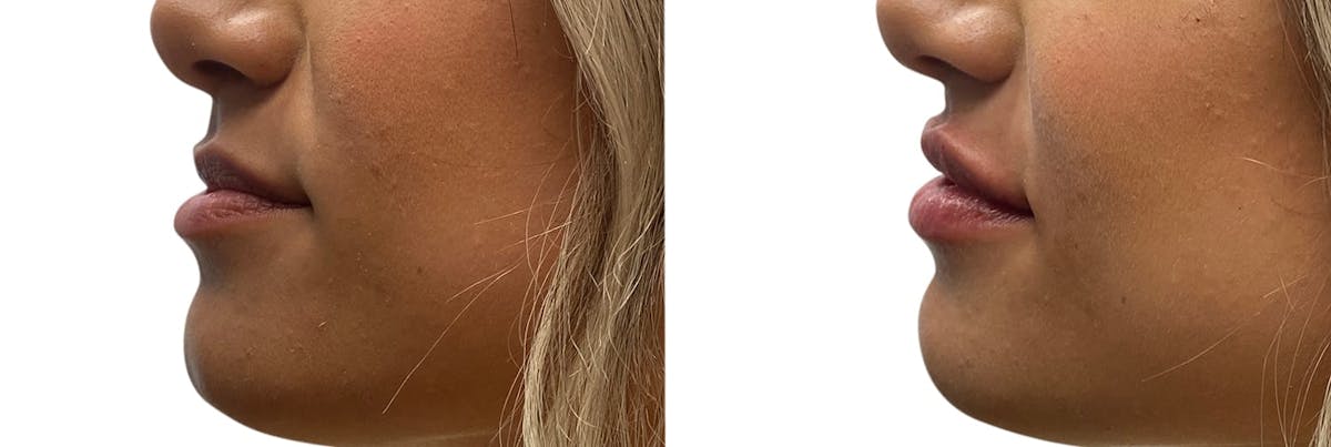Lip Enhancement Before & After Gallery - Patient 394197 - Image 2