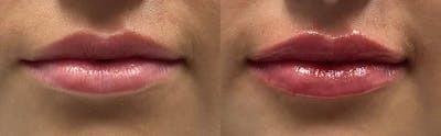 Lip Enhancement Before & After Gallery - Patient 248473 - Image 1
