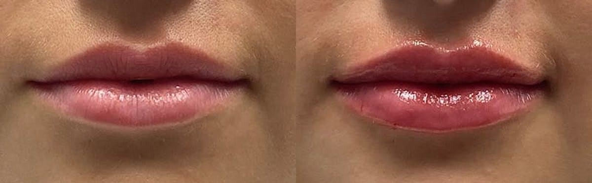 Lip Enhancement Before & After Gallery - Patient 248473 - Image 1