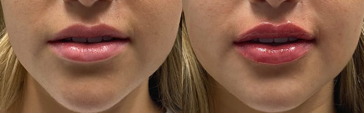 Lip Enhancement Before & After Gallery - Patient 248473 - Image 2