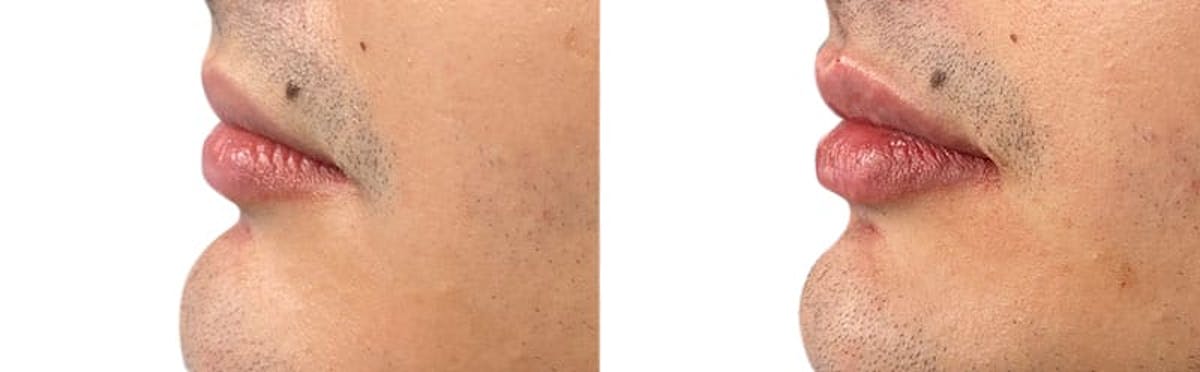 Lip Enhancement Before & After Gallery - Patient 260420 - Image 1
