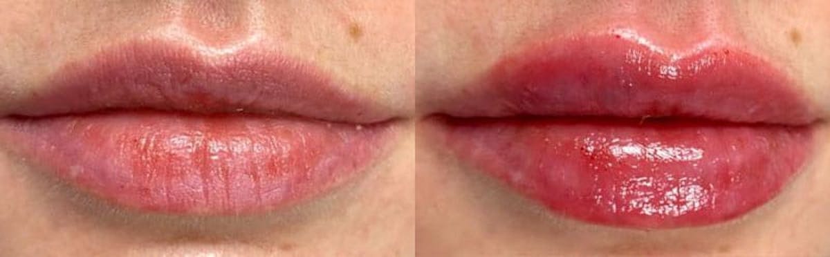 Lip Enhancement Before & After Gallery - Patient 356723 - Image 1