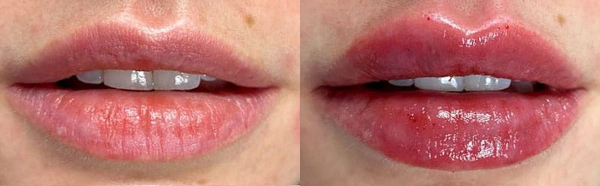 Lip Enhancement Before & After Gallery - Patient 356723 - Image 2