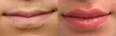 Lip Enhancement Before & After Gallery - Patient 170502 - Image 1