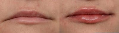 Lip Enhancement Before & After Gallery - Patient 378923 - Image 1