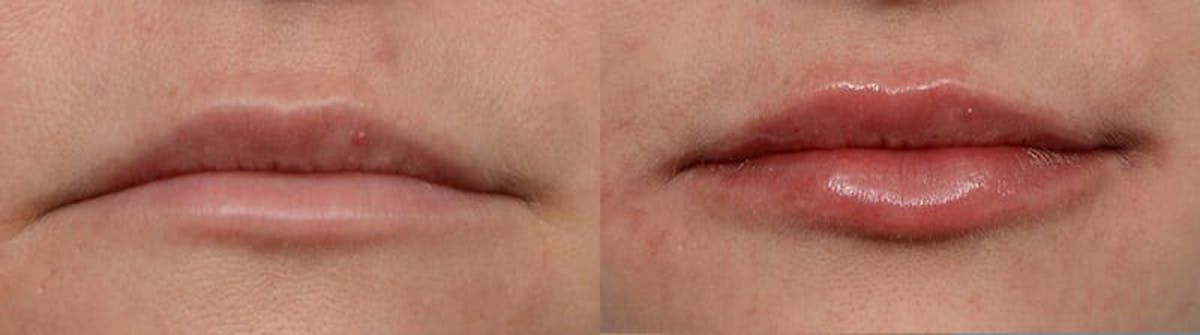Lip Enhancement Before & After Gallery - Patient 378923 - Image 1