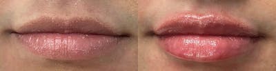 Lip Enhancement Before & After Gallery - Patient 843519 - Image 1