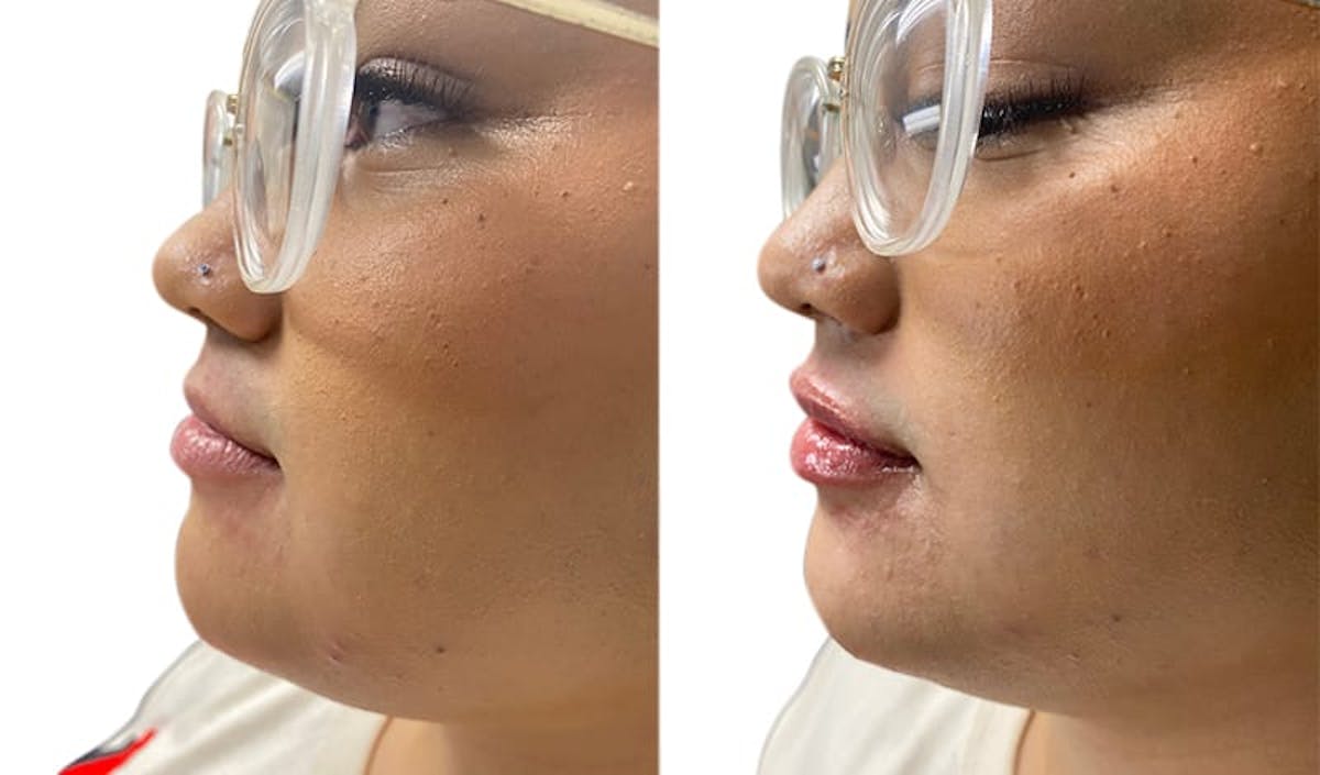 Lip Enhancement Before & After Gallery - Patient 843519 - Image 2