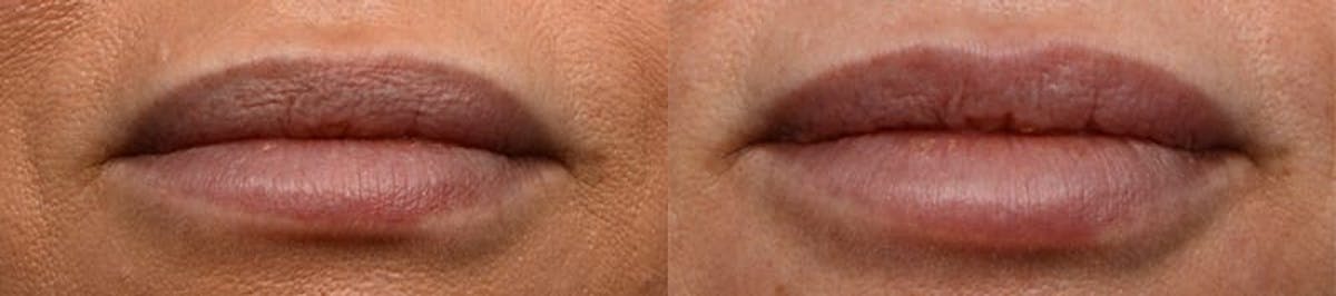 Lip Enhancement Before & After Gallery - Patient 262341 - Image 1