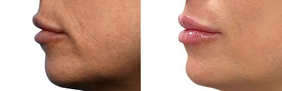 Lip Enhancement Before & After Gallery - Patient 751934 - Image 1